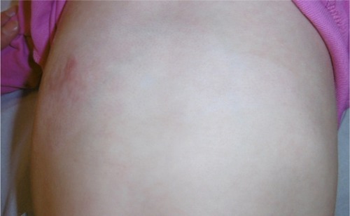 Figure 16 Recovery after 2 months of tested topical cream.