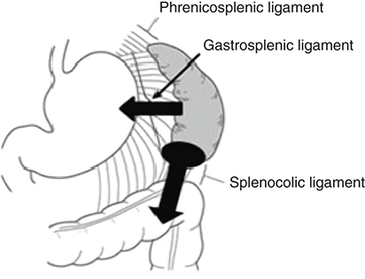 Figure 2. The mechanism of splenic rupture in our case.Arrows: traction on the splenocolic and gastrosplenic ligaments.