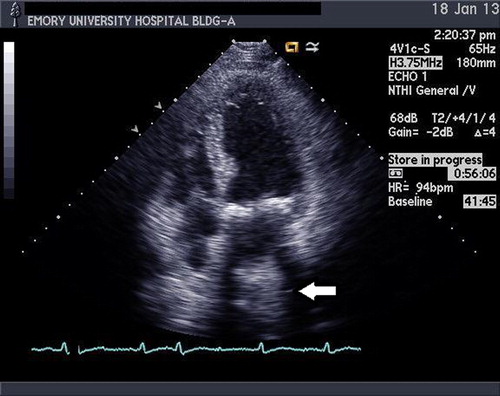 Figure 1. Two-dimensional transthoracic echocardiography image. Four-chamber apical view indicative of mass in the left atrium (white arrow).