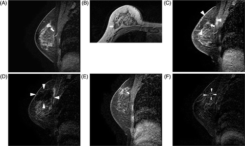 Figure 2. Dynamic MRI findings of patient 1 mentioned in Table II. (A) An early post-contrast sagittal T1-weighted image prior to HIFU showed a 12 mm, irregular enhancing mass (arrow). (B) A pre-contrast axial T1-weighted image of MRI post-HIFU revealed an isointense index tumour (arrow). (C) An early post-contrast sagittal T1-weighted image of MRI post-HIFU revealed an index tumour, isointense to adjacent parenchyma (arrow). It was surrounded by an ablation zone of decreased signal intensity (arrowheads). (D) The ablation zone on a delayed subtraction image of MRI post-HIFU was demarcated by dark signal intensity. Although no enhancement of the index tumour was observed, an incomplete thin rim enhancement was present (arrowheads). (E) An early post-contrast sagittal T1 weighted image of 12 months FU MRI, the size of the index tumour (arrow) had decreased to 5 mm. (F) The size of the ablation zone surrounded by a thin rim enhancement (arrowheads) had also decreased on a delayed subtraction image of 30 months FU MRI.