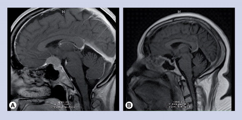 Figure 2. Tuberculum sellae tumor resected via transpalpebral approach.(A) Preoperative sagittal MR contrast-weighted scan demonstrating tuberculum sella meningioma. (B) Postoperative sagittal MR contrast-weighted scan demonstrating gross total resection.