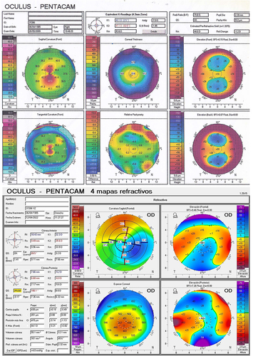 Figure 2 Top: preoperative Scheimpflug analysis; Bottom: 13 years postoperative Scheimpflug analysis of the case presenting an extreme flattening of 11.5D in the steeper keratometry.