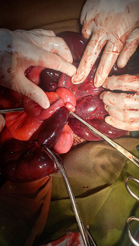 Figure 2 Tight ileal knots.