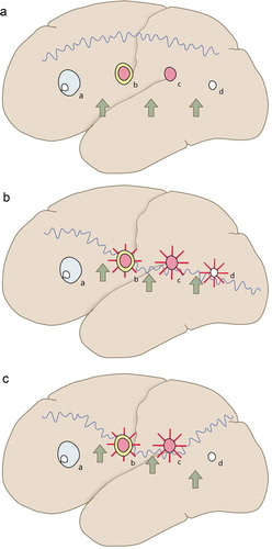 Figure 2. Multifactorial basis of epilepsy in patients with neurocysticercosis. (A) Three factors involved in epileptogenesis in NC. (Top) Sinuous line indicates seizure threshold or propensity for a seizure to occur. (Middle) Represents structural lesion due to the parasite evolutionary phase that changes over time: a, viable; b, colloidal; c, granular-nodular; and d, calcified cyst. The evolution of cysts phases lasts around 6 months on average, from the viable to calcified stage. (Bottom) Arrows illustrate potential precipitating factors or a cascade of mechanisms that may contribute to trigger seizures. Someone with a high threshold may have parasitic epileptogenic lesions and never have seizures (i.e. asymptomatic patients). (B) Someone with a low threshold could have acute seizures, as indicated by the red lines around the cysts (i.e. ictogenesis) due to parasitic epileptogenic lesions and precipitating factors, and seizures recur over time since there is a genetic predisposition to maintain low threshold (i.e. epileptogenesis). (C) Someone with a low threshold could have acute seizures due to parasitic epileptogenic lesions and precipitating factors, but seizures do not recur, since there is no genetic predisposition to maintain a low threshold and they do not evolve into epilepsy. Republished with permission from [Citation51].