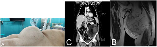 Figure 1. The patient’s pre-operative photo and the patient’s clinical photo. A left thigh tumor 30 × 30 cm in size can be seen (a). Magnetic resonance imaging of the thigh is showing heterogeneous mass with fat content on the ventral side of the left thigh that is compressing the upper leg muscles (B). Computed tomography image of the abdomen and pelvis is showing the formation occupying a large part of the left hemiabdomen. Also, the tumor is compressing the descending colon to the right and is reaching the kidney which is pushed cranially (C).