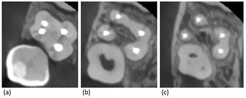 Figure 2 Post-operative Cone Beam Computed Tomography scan (axial sections) for tooth #17. (a) Coronal root view showing 4 obturated canals. (b) Mid root view showing separate mesio-buccal canal in addition to disto-buccal, mesio-palatal, and disto-palatal canals. (c) Apical root view showing two separate mesio-buccal and disto-buccal roots, and one bifid palatal root encasing two palatal canals.