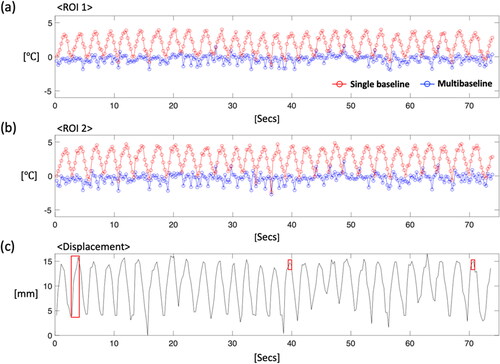 Figure 8. Time-dependent profiles within ROI 1 (a, left kidney) and ROI 2 (b, right kidney) (volunteer #1). ROIs are shown with cyan circles in Figure 7. A single baseline reconstruction shows periodic patterns corresponding to (c) the respiratory motion, while a multi-baseline acquisition allows stable temperature measurements. The red box indicates time points for temperature maps shown in Figure 7.