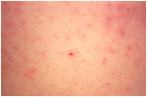 Figure 5. Scabies. Erythematous papules on the abdomen due to hypersensitivity to the scabies mite. Image by Joe Miller. Reprinted from public domain Centers for disease Control and Prevention public Health Image Library; Retrieved from https://phil.cdc.gov/details.aspx?pid=15382.