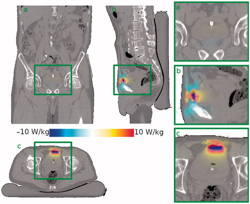 Figure 1. Effect of the presence of an air pocket on the SAR distribution in a typical patient (patient #6) compared to the situation without air pocket. The effect is mostly localised around the air pocket. Shown are (a) a coronal view, (b) a sagittal view and (c) a transversal view through the bladder’s center of gravity. The right-hand column shows zoomed in versions of the bladder region.