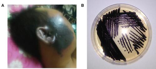 Figure 2 Picture of a patient with black purplish abscess in the right cheek extending to the right ear (A) and Chromobacterium violaceum shown on a culture plate (B). Notes: Reproduced from Darmawan G, Kusumawardhani RY, Alisjahbana B, Fadjari TH. Chromobacterium violaceum: the Deadly Sepsis. Acta Med Indones. 2018;50(1):80–81.2 Creative Commons Attribution 4.0 International License (https://creativecommons.org/licenses/by/4.0/legalcode).