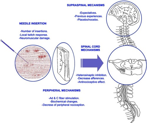 Figure 1 Proposed model explaining potential variables influencing neurophysiological mechanisms of trigger point dry needling.