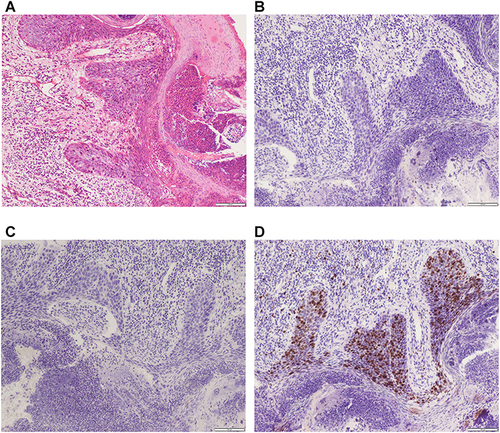 Figure 2 Histological pathogenesis of the resected specimen. (A) H&E staining. (B) Immunohistochemical staining of cytokeratin 7, (C) cytokeratin 20, and (D) Ki67. Scale bar: 100 μm.