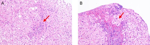 Figure 3. Histological examination demonstrated the presence of interfacial hepatitis (A) and rosettes of hepatocytes (B).