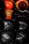 Figure 6 Anterior segment images of Case 5 (left eye). (A) A papillomatous red tumor involving the temporal cornea and limbus (red arrow), with corneal grey and white elevation and central cavitation (black arrow). (B) A palpebral fissure was found in the nasal quadrant (red arrow). (C) The tumor completely disappeared after treatment, with tiny palpebral fissures remaining. (D) AS-OCT demonstrated an abrupt transition between unremarkable and thickened hyper-reflective epithelia. However, in this large lesion, a shadow from the hyper-reflective epithelium sometimes obscured that plane of cleavage (red dots) and a small plane of cleavage between the lesion and the underlying tissue in cornea (yellow dots region). (E) The neoplasm completely resolved, with palpebral fissures remaining after treatment (red dots). (F) The leakage from both the tumor and its feeding vessels (red arrow), as well as corneal neovascularization (black arrow) was observed through FA. (G) ICGA results showed both seafan-shaped intratumoral vessels and conjunctival feeding vessels (red arrow) clearly, as well as corneal neovascularization (black arrow). (H) No leakage was found, and the regression of corneal neovascularization was observed after treatment via FA. (I) Intratumoral vessels, conjunctival feeding vessels, and corneal neovascularization disappeared; only a patched ischemic region remained (red arrow) visible on anterior segment ICGA images after treatment.Abbreviations: AS-OCT, anterior segment optical coherence tomography; FA, fluorescein angiography; ICGA, conjunctival indocyanine green angiography.