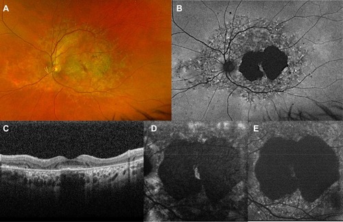 Figure 2 Ultra-widefield fundus photograph and autofluorescence of an advanced form of STGD1. The area of RPE mottling is comprised between the vascular arcades and broadens nasally to the optic disc (A, B). The macular area shows a marked hypofluorescence, with a little amount of foveal sparing (C). The OCT scan (C) demonstrates irregularity in the subfoveal RPE-photoreceptors complex and extensive atrophy in RPE and external retinal layers in the peri- and para-foveal areas. Foveal sparing is better seen on near-infrared autofluorescence (D) rather than short wavelength autofluorescence (E).