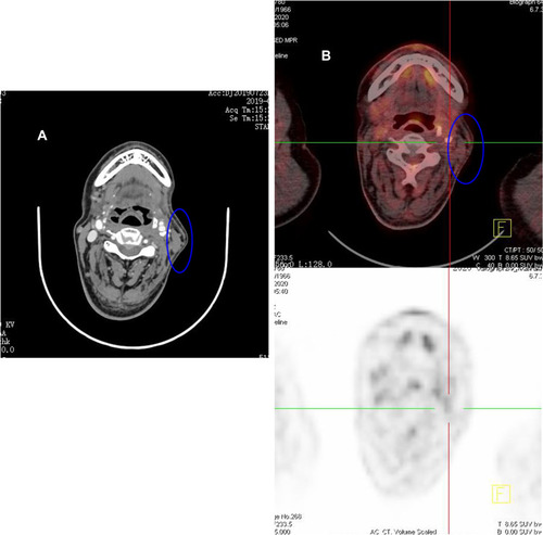 Figure 3 Imaging findings of case 3. (A) The enhanced CT of the last disease progression showed left cervical lymphadenopathy (it can be seen in the blue coil). It was considered disease of progress according to the pathological findings and the symptom of fever. (B) PET-CT showed no abnormal hypermetabolic foci in the original cervical lymph node (it can be seen in the blue coil) after 6 cycles of PCET treatment. It means that he achieved clinical CR.