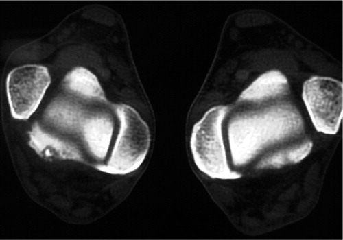 Figure 7. Case 3. CT of the distal tibia, showing the osteoid osteoma.