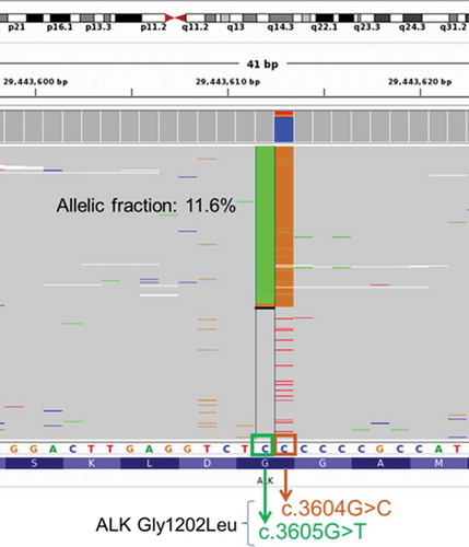 Figure 2. Illustration of the novel ALK G1202L mutation detected from the patient at PD from brigatinib therapy. ALK G1202L is a missense mutations resulting from dinucleotide substitution in the exon 23 of the ALK gene (NM_004304.4:c.3604_3605delGGinsCT p.Gly1202Leu). Green column represents reads with c.3605 G > T, while orange column represents reads with c.3604 G > C. Each gray row represents the sequencing read from a DNA fragment. Bottom bar shows the protein sequence annotation of ALK