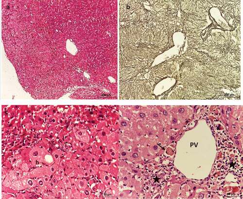 Figure 7. Photomicrograph of sections of liver of HCC mice treated with MET (250 mg/kg) showing altered architecture. (a & c) stained with Hx & E, (b) stained with silver nitrate. (a) shows hepatic lobules with numerous dilated portal veins and sinusoids. (b) shows fibrosis, (c) shows large and vacuolated hepatocytes (h) with large nuclei, and (d) shows dilated portal vein (PV), apoptotic cells (arrow) and periportal inflammation (asterisks).