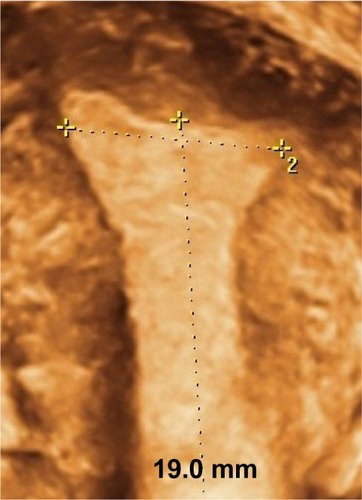 Figure 5 3-D coronal view of the uterine cavity, demonstrating the measurement of the fundal transverse dimension (19.0 mm).