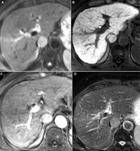 Figure 6 Axial images in a 72-year-old man with HCC.