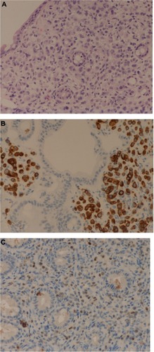 Figure 4 Biopsy of colonic mucosa.