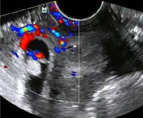 Figure 1 Ultrasonography image taken at 7 weeks’ gestation showed the gestational sac to be located beneath the uterine cavity, which was surrounded by rich blood flow signal.