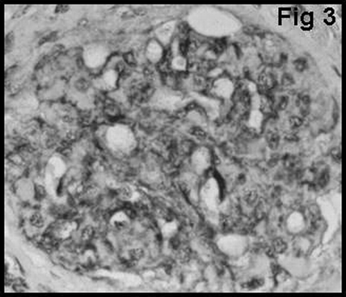 Figure 3 Global mesangial vWF staining in the glomerulus.