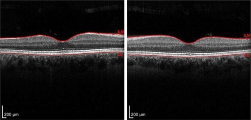 Figure 3 Time-domain OCT (Cirrus™, Carl Zeiss Meditec) from Case 2.