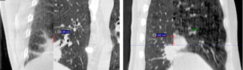 Figure 3. A large mismatch of the caudal target of patient #3 on the 10th treatment day shown in split window of the planning CT (left) and CBCT (right) in coronal and sagittal views.