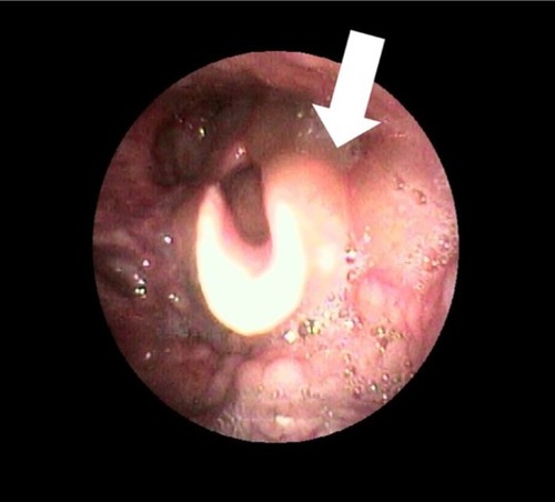 Figure 3 Fiberscopic image showing edema (arrow) from the epiglottis to the left lateral arytenoid cartilage.