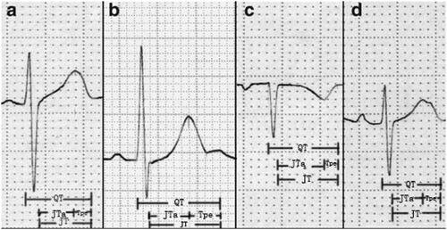 Figure 1. Measurement of RV indicators. The measurement of QT starts from the Q wave to the end of the T wave, including the QRS wave, the ST segment, and the T wave. JT is defined as the QT to remove the QRS wave portion. Tpe starts from the T peak and ends at the T wave. JTa is the interval between the J point and the apex of the T wave b. When there is a U wave, the T wave end is defined as the lowest point of the curve between the T wave and the U wave.c. In the p-wave inverted electrocardiogram, the representation of QT interval, Tpe, JT and JTa.d. In the bi-peak ECG of T wave, the representation of QT interval, Tpe, JT and JTa.