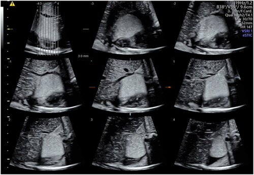 Figure 3. Three-dimensional reconstruction of the rhabdomyoma at 37 weeks by Tomographic Ultrasound Imaging (TUI).