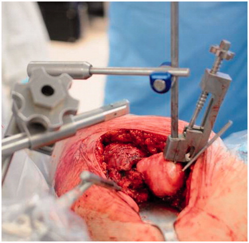 Figure 2. Intraoperative photograph showing a new femoral fixator clamp attached to the femoral head.