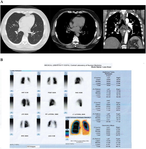 Figure 2. CTPA (A) and P-SPECT (B) of Case 2. (A) CTPA with no filling defects in pulmonary artery, its main, lobar and segmental branches, which are of normal size. (B) Perfusion SPECT/CT showing both side hypoperfusion in the subsegmental level of pulmonary artery.