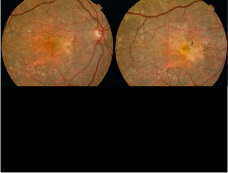 Figure 3 Pre- and post-ranibizumab therapy showing increase in macular fibrosis.
