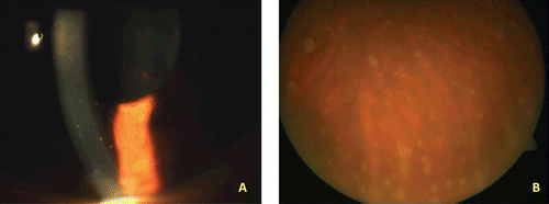 FIGURE 1  A: Biomicroscopy of left eye showing anterior granulomatous uveitis. B: Funduscopy of left eye showing snow-balls in the inferior vitreous cavity.