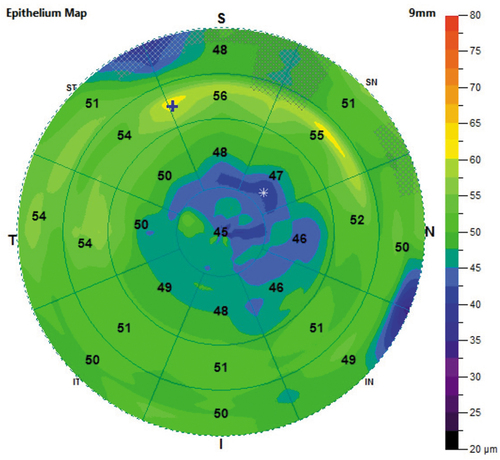 Figure 1. An example of epithelium map from the OCT pachymetry report. The epithelium maps were drawn according to the default colour-coded scale. It consists of 25 sectors, including a 2-mm radius central zone and eight octants equally distributed within paracentral (2–5 mm), mid-peripheral (5–7 mm), and peripheral (7–9 mm) annular zones. Mean epithelial thickness was shown within each sector and the area of minimum and maximum thickness were indicated as * and + on the map, respectively.