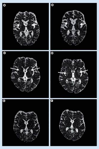Figure 4. Diffusivity maps at the level of mid-striatum in individual patients with the Parkinson variant of multiple system atrophy.n = 2; (A) baseline; (B) follow-up in one patient; (C) baseline; (D) follow-up in another patient and Parkinson’s disease (E) baseline; (F) follow-up. Note the diffuse hyperintensity – corresponding to increased diffusivity – in the putamina of the patient with Parkinson variant of multiple system atrophy (arrows in A–D), which are increased at follow-up (B & D) compared with baseline examination (A & C). The Parkinson’s disease patient shows no increased diffusivity in the putamen, neither at baseline (E) nor at follow-up (F). Of the diffusivity changes during follow-up, only putaminal diffusivity increased significantly in the Parkinson variant of multiple system atrophy group, while none of the diffusivity values in the basal ganglia regions in the Parkinson’s disease patients changed at follow-up compared with baseline. Moreover, no progression of any putaminal abnormalities was shown using semiquantitative ratings of abnormalities on structural MRI.Modified with permission from [Citation24].