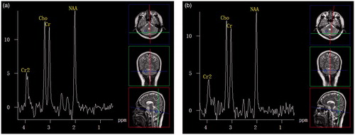 Figure 1. Healthy volunteer during summer and winter. (a) Proton MR spectra image of the cerebellum obtained in a 28-year-old healthy man during summer. (b) Proton MR spectra image of the cerebellum obtained in the same man during winter. The image shows no difference with the previous image.