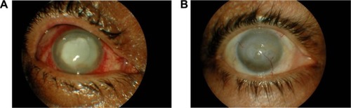 Figure 1 (A) A case in group A before treatment; (B) after treatment.