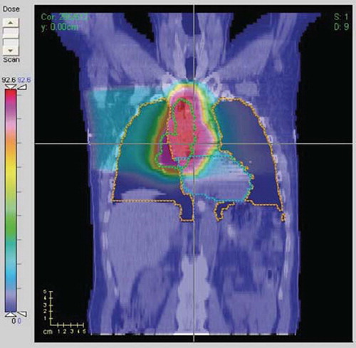 Figure 1. Coronal view of a treatment plan with a significant high dose overlap with the heart (yellow contour line: whole lung; green contour line: PTV; blue contour line: heart).