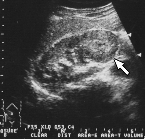 Figure 1. Ultrasound of case 16. A 4-cm hypoechoic mass (arrow) in the lower pole of the right kidney.