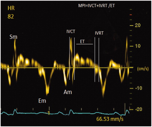 Figure 1. Intervals, velocities and MPI with tissue doppler imaging. IVRT: Isovolumetric Relaxation Time; IVCT: Isovolumetric Contraction Time; ET: Ejection Time; MPI: Myocardial Performance Index Em: Early diastolic mitral annular velocity; Am: Late diastolic velocity; Sm: Systolic peak velocity.