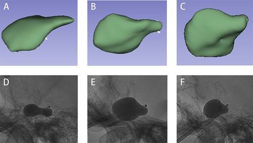 Figure 5 The classification of the model in lateral view. (A–C): The shape of the model of the Meckel’s cave is classified into thin “pear”, standard “pear” and square “pear” based on W1/L1; (D–F): The corresponding intraoperative balloons for each kind of “pear”.