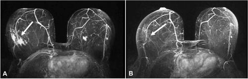 Figure 3 (A) Preoperative and pre-treatment MRI image of IMPC. White arrow indicates the central mass of the lesion along with mass and non-mass enhancement. (B) MRI findings post-PST consistent with complete pathologic response. White arrow indicates local scarring in the mass area after PST. Although imaging indicated complete pathological response, residual disease was still found in the scarring area when examined under a microscope, and complete mastectomy was deemed appropriate.