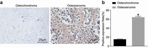 Figure 2. Osteosarcoma tissues exhibit increased positive rates of HGF protein. A: Immunohistochemistry staining of osteochondroma tissues (n = 35) and osteosarcoma tissues (n = 72); B: HGF positive rate in osteochondroma and osteosarcoma tissues; *, p < 0.05 compared with osteochondroma tissues. Data were presented as mean ± standard deviation and the comparison between two groups was analysed by t-test.