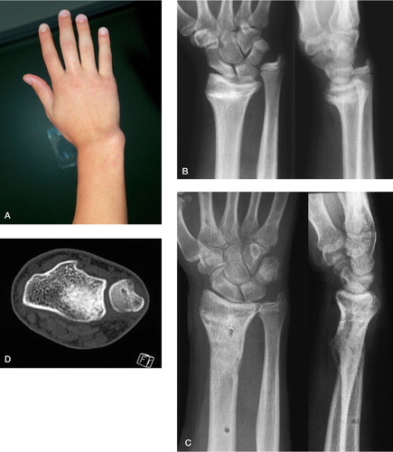 Figure 2. Patient 1. A and B. Pseudo‐Madelung deformity of the right distal radius after physial injury and closed radial growth plate. At the time of correction, the ulnar growth plate was in stage G according to the Tanner and Whitehouse scale. C and D. After deformity correction, with an almost normal functioning wrist and anatomically reduced DRUJ 1 year after correction.