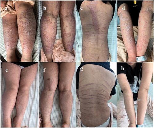 Figure 1. Diffuse distribution of plaques and scales on the back (c) and extremities (a,b,d) before treatment. Psoriasis Area and Severity Index (PASI) score was 47.0. The lesions completely subsided after one month of secukinumab treatment (e–h). PASI score was 0.
