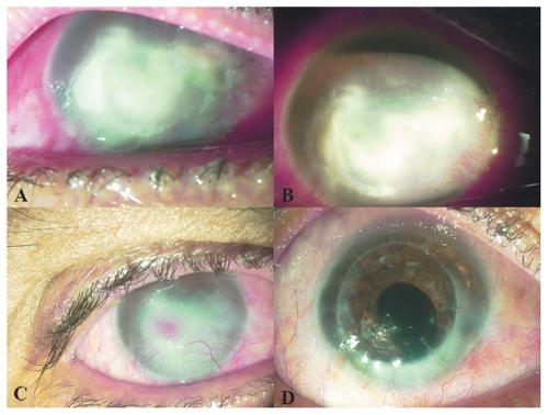 Figure 2 Appearance of case 2 (A) at initial presentation, (B) 1 week after crosslinking (note the cleaner margins and decreased infiltrate density of the abscess), (C) 2 months after crosslinking (infiltration has been replaced by scar tissue; note the presence of an intrastromal hemorrhage), and (D) after penetrating keratoplasty combined with cataract extraction.